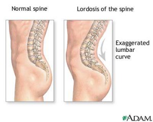 Spine Hyperextension